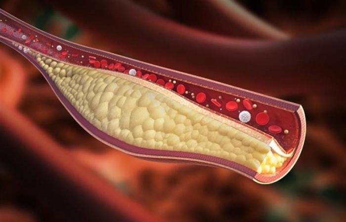 احذر ارتفاع الكوليسترول في سن مبكرة.. يؤدي إلى الإصابة بتصلب الشرايين