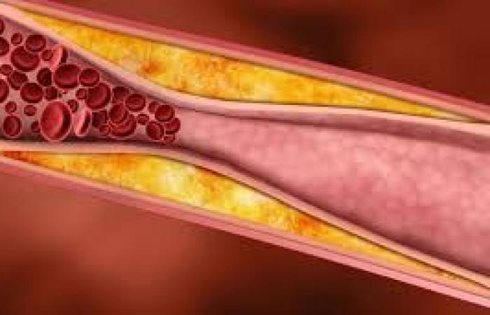 مخاطر ارتفاع مستويات الكوليسترول.. هل يؤدي للإصابة بتصلب الشرايين؟