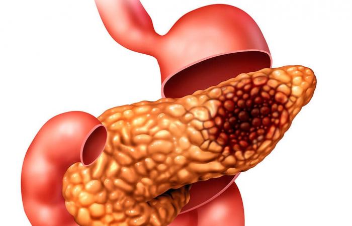 إطلاق أول أداة من نوعها للتحقق من المخاطر الوراثية المحتملة للإصابة بسرطان البنكرياس| تفاصيل