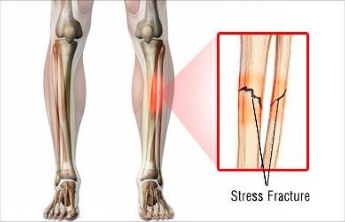 علاج كسور الإجهاد.. وهذه النصائح قد تساعد في الوقاية
