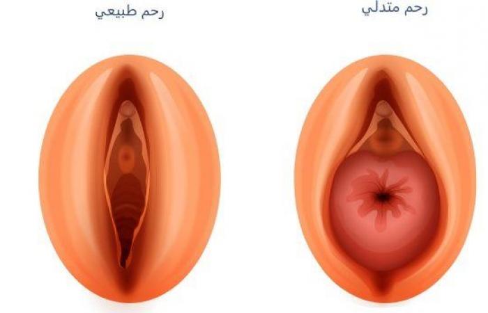 هبوط الرحم.. تعرفي على الأسباب والأعراض والعلاج