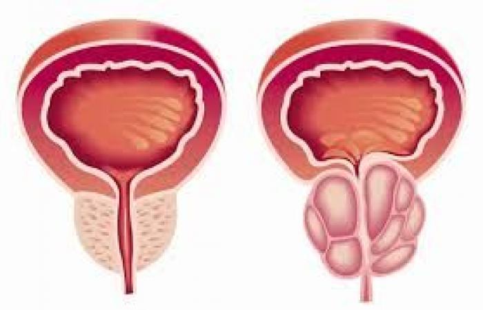 علاج جديد محتمل لنوع فرعي من سرطان البروستاتا العدواني